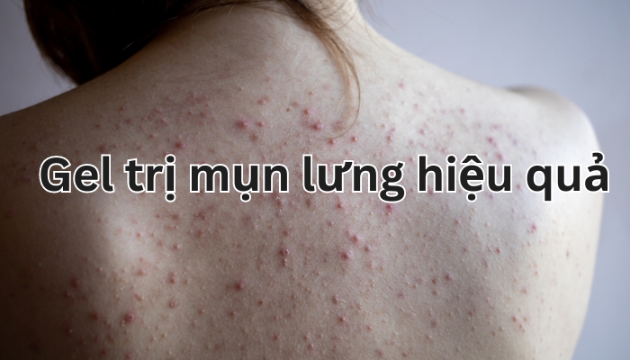 gel trị mụn lưng